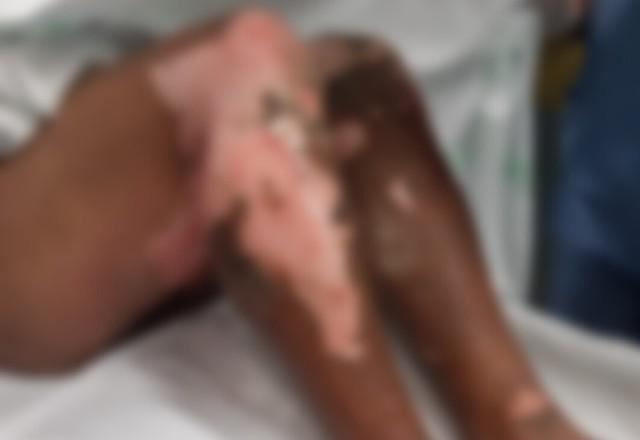 Criminosos ateiam fogo no corpo de turista em Florianópolis