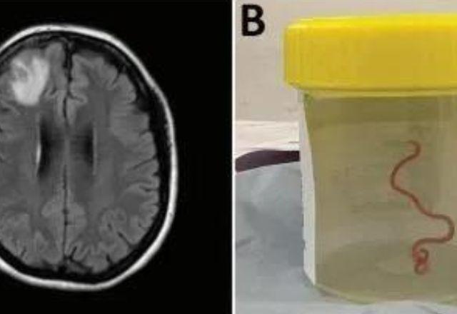Verme comum em cobras píton é achado no cérebro humano pela primeira vez