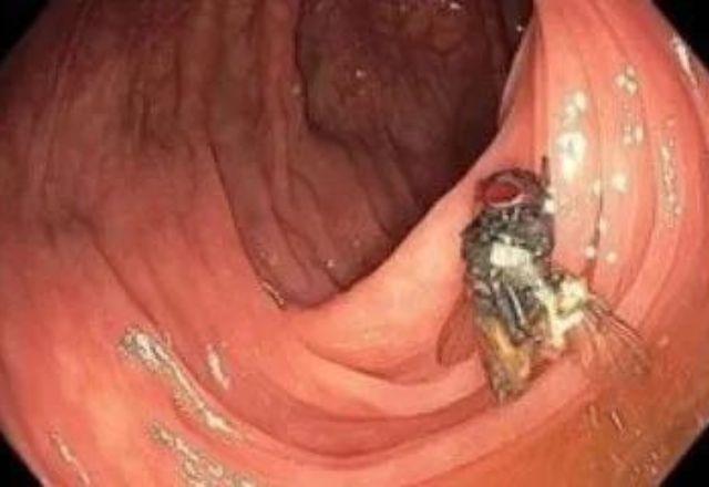 Médicos encontram mosca viva dentro de intestino de paciente durante exame